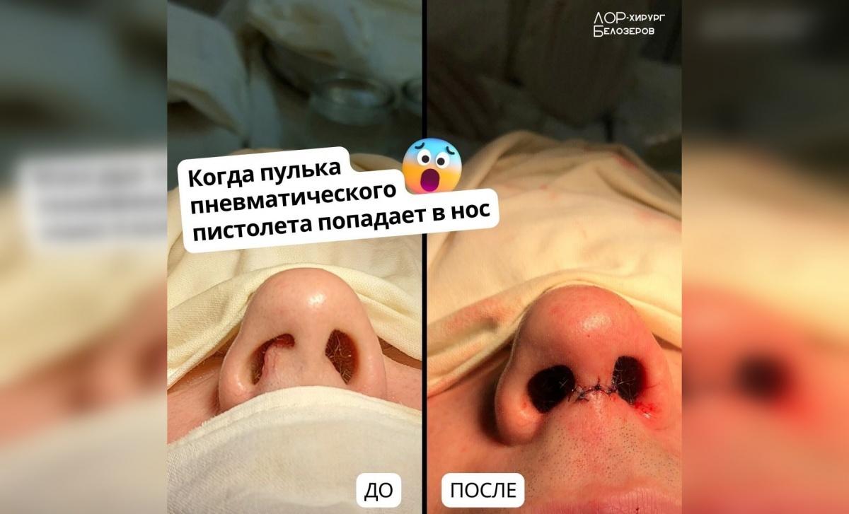Пострадавший от пули нос мужчины восстановили нижегородские врачи - фото 1