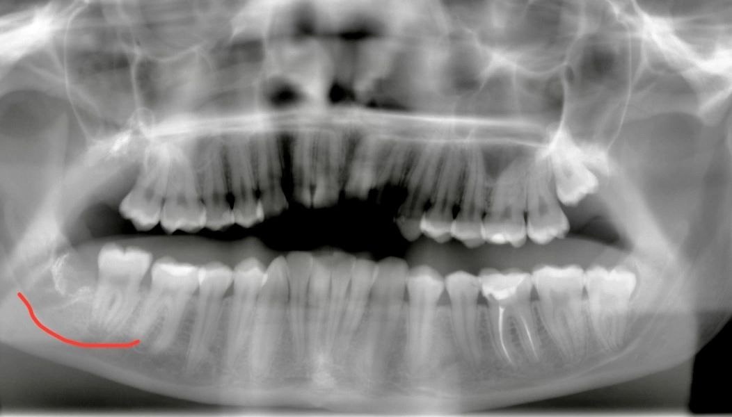 Нижегородцам напомнили о возможности пересадки зубов - фото 1